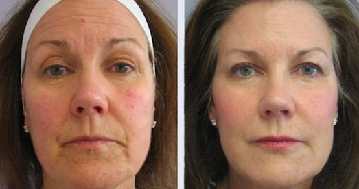 Radiofrecuencia Facial antes y después